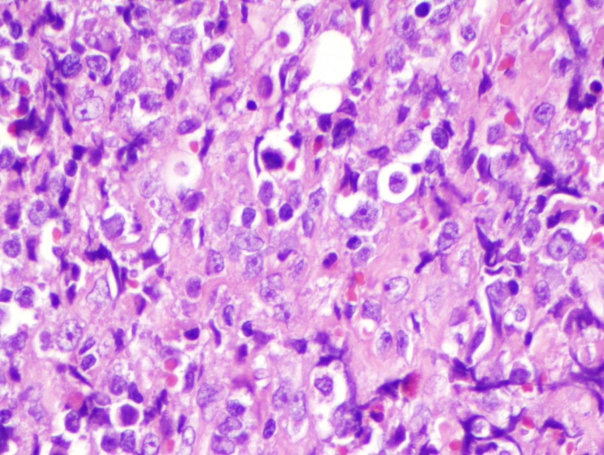 H) Subsequently biopsied myeloid sarcoma (H&E, 1000x oil)
